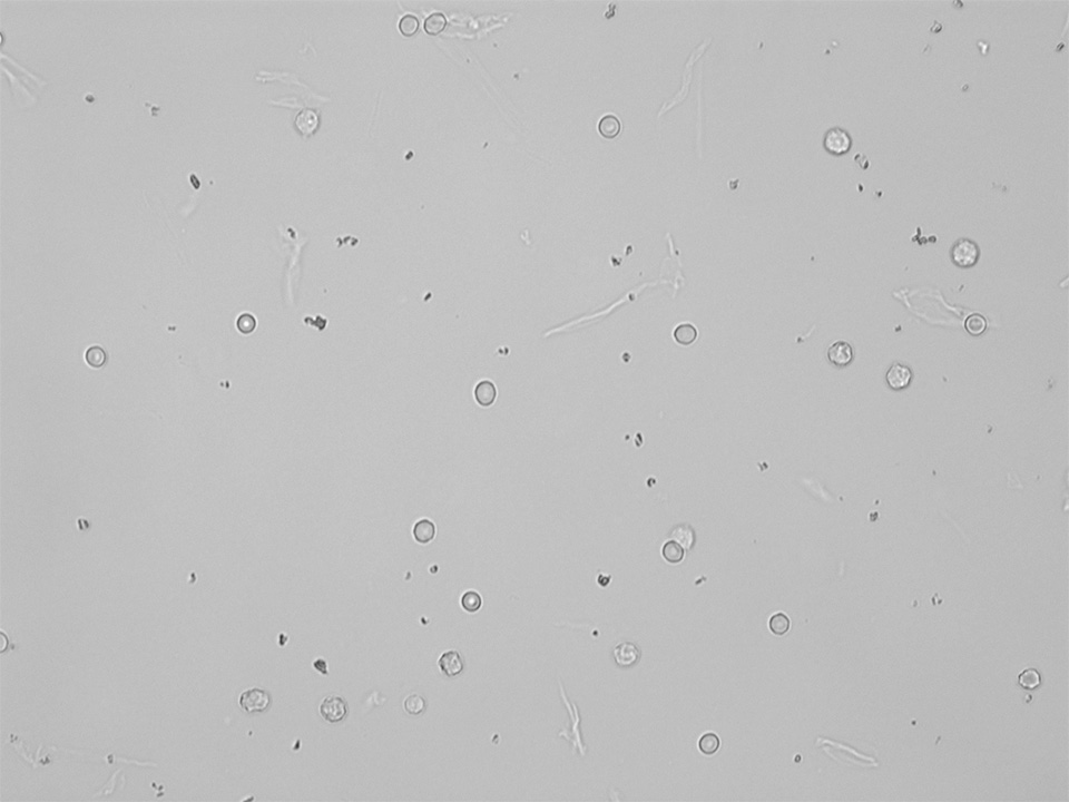 urine test / urine microscopy findings